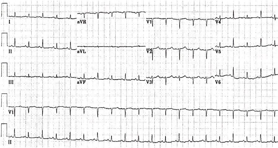 TOP 100 ECG QUIZ LITFL 011