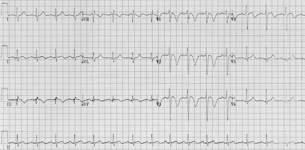 TOP 100 ECG QUIZ LITFL 007 2