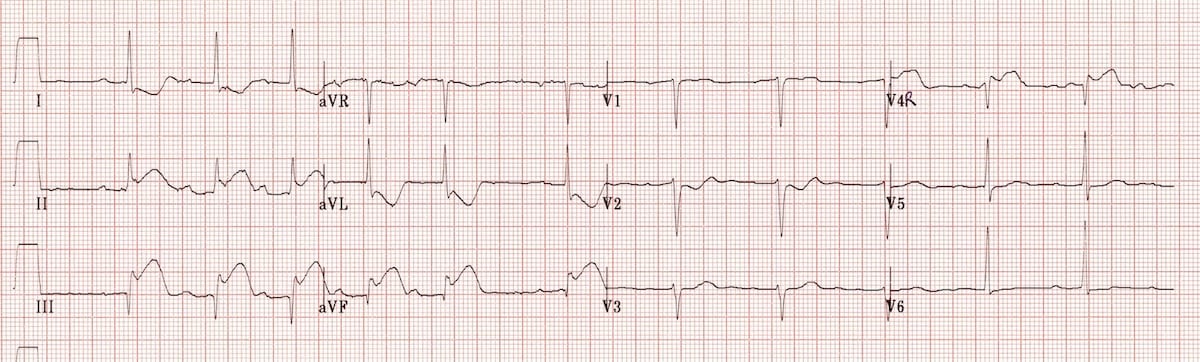 ECG Right ventricular infarction 2