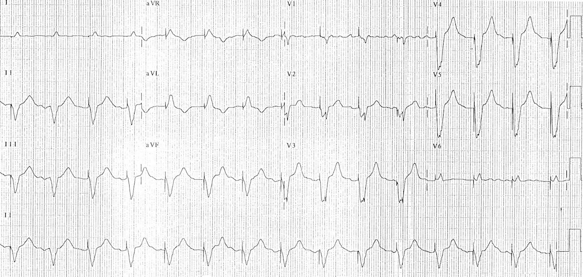 Ventricular-pacing 2
