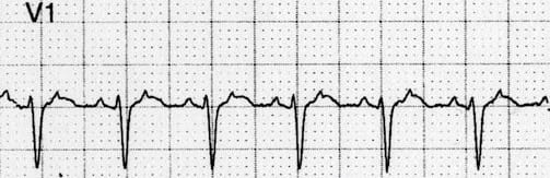 ECG Flutter waves in V1