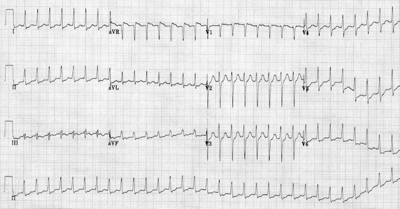 ECG SVT-ST-depression 2