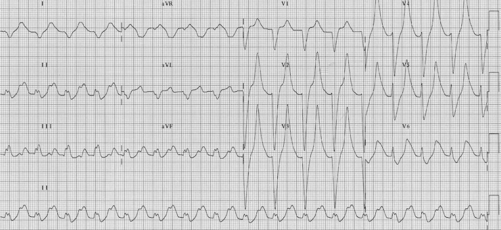 TOP 100 ECG QUIZ LITFL 027 2