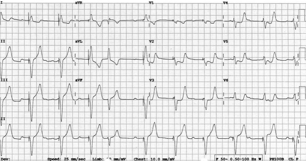 TOP 100 ECG QUIZ LITFL 045