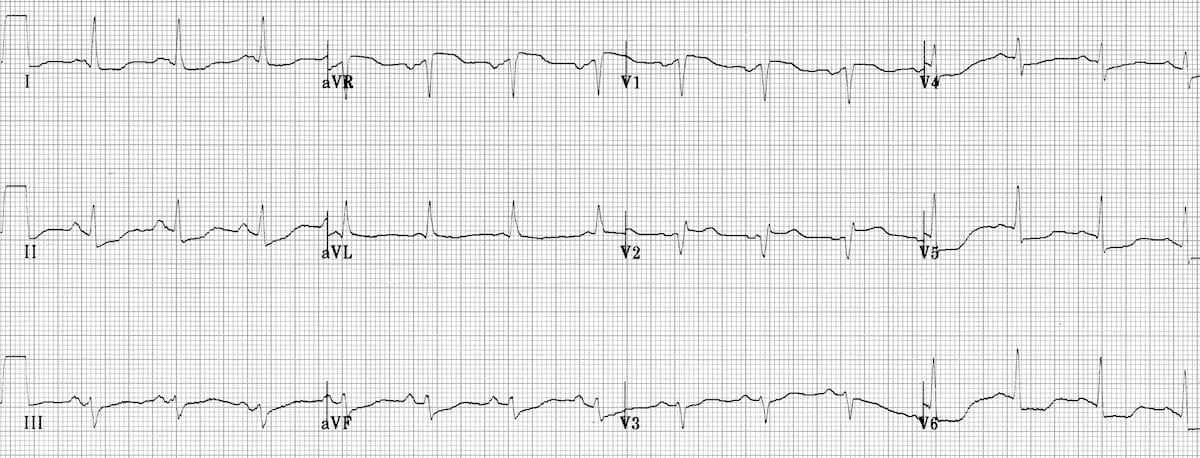 Proximal LAD STEMI ECG