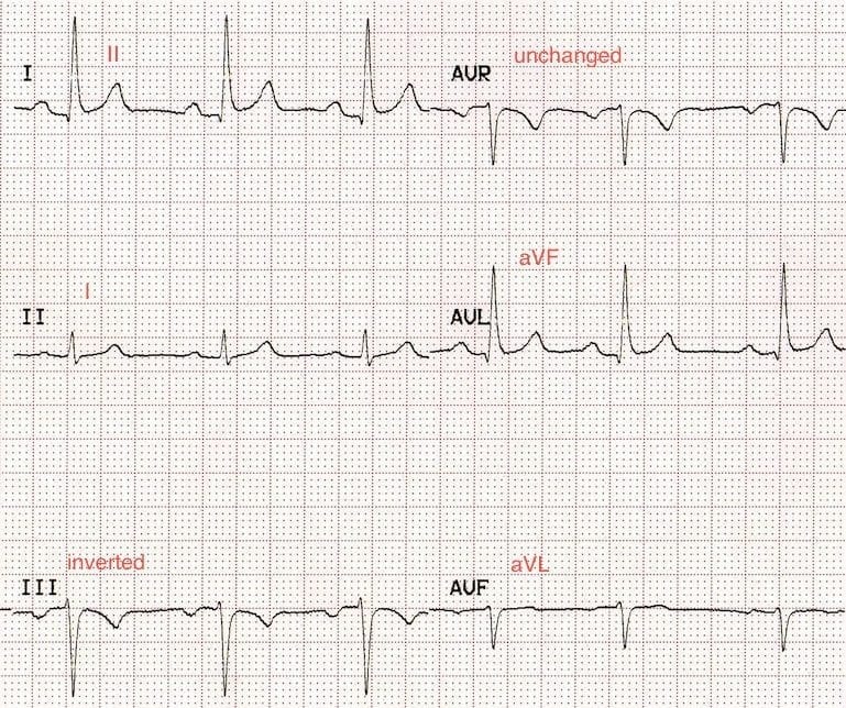 ECG Leads LA LL Reversal