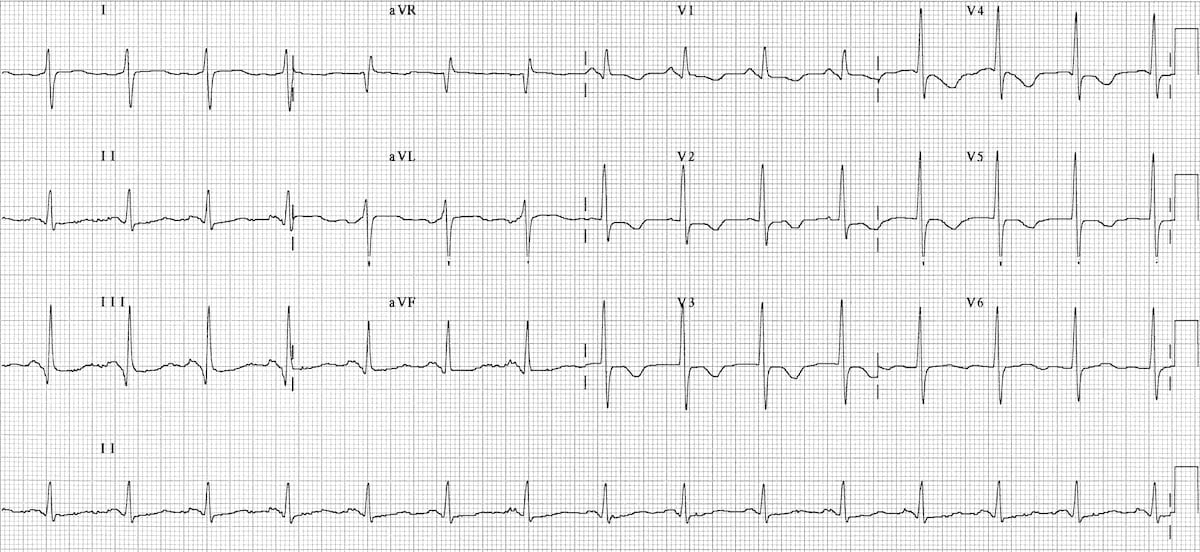 ECG right sided pulmonary embolus