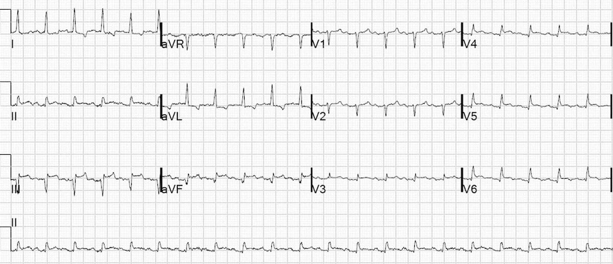 Inferior Left Ventricular Aneurysm 2