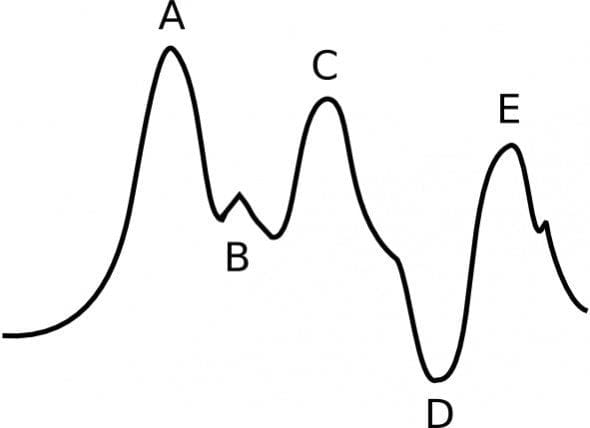 IABP Waveform