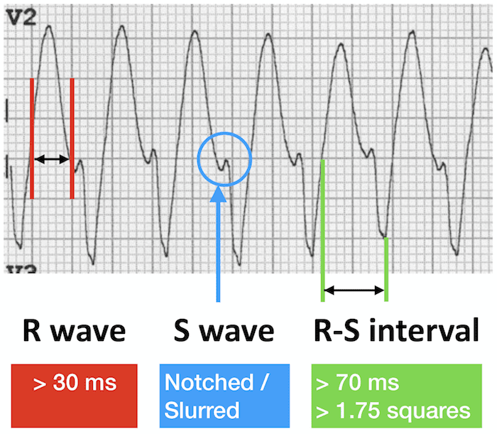 ECG VT V2 S wave notch Josephson sign 700