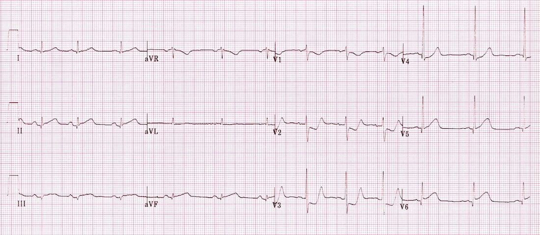 ECG Posterior AMI 3b