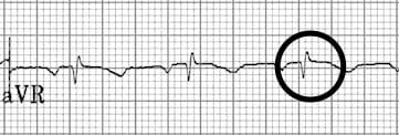 Retrograde P waves in aVR resolved