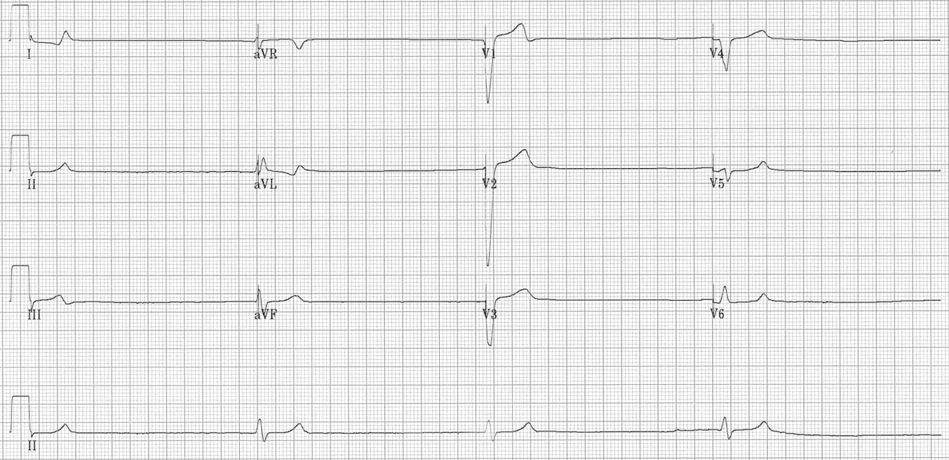 Sinus arrest ventricular escape rhythm