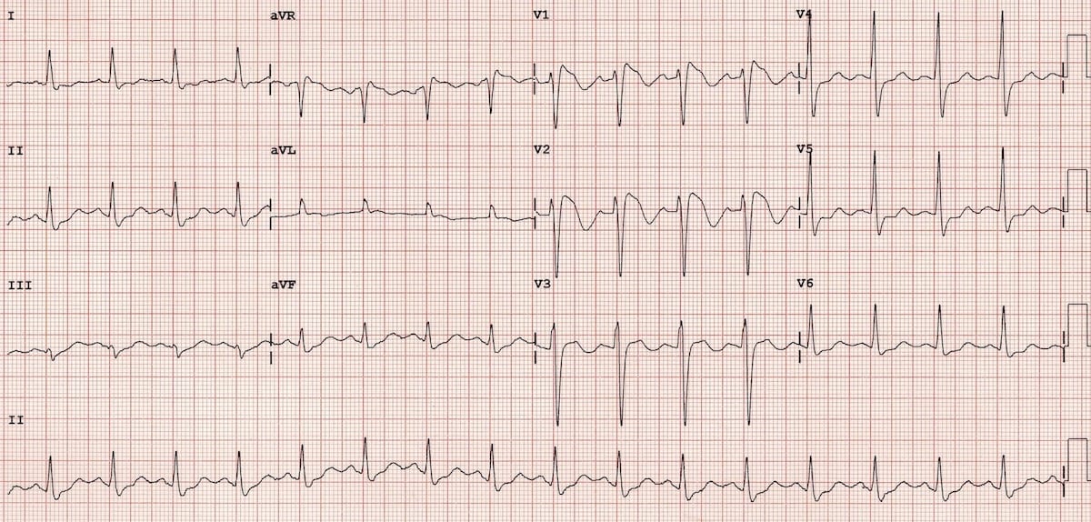 ECG Brugada Tyope 1 RBBB mimic 2