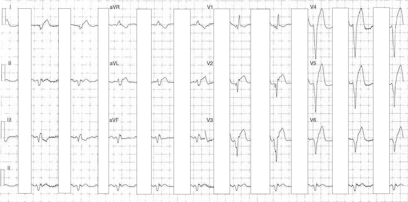 ECG Case 089b LITFL Top 100 EKG