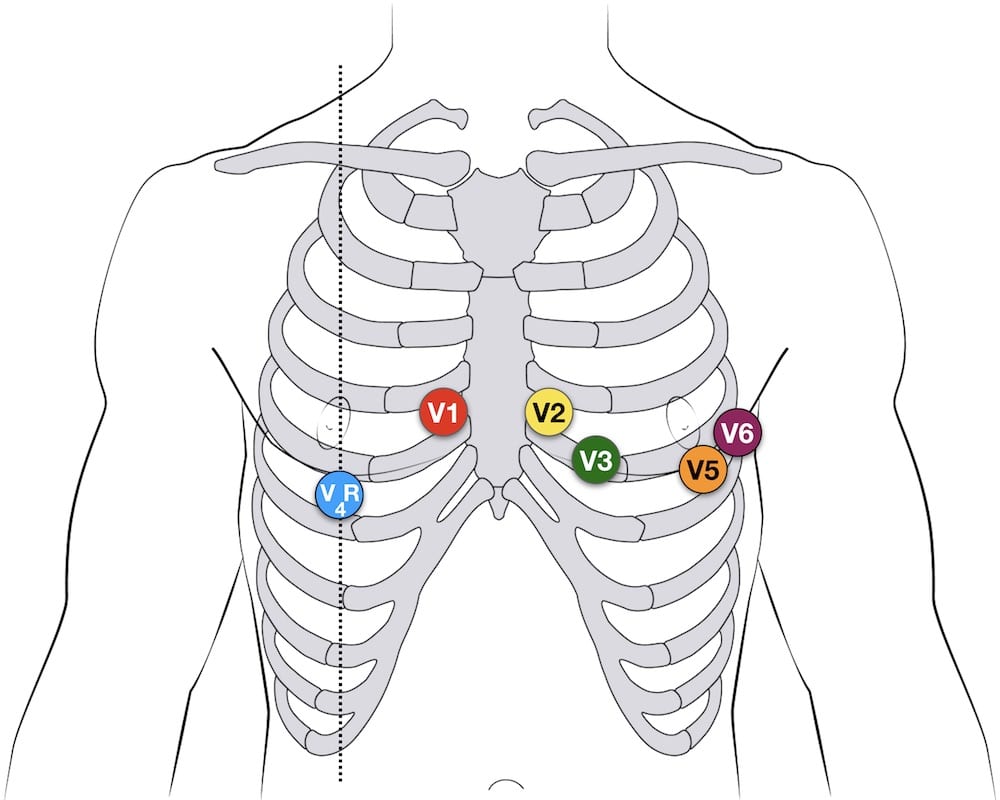 V4R ECG lead placement