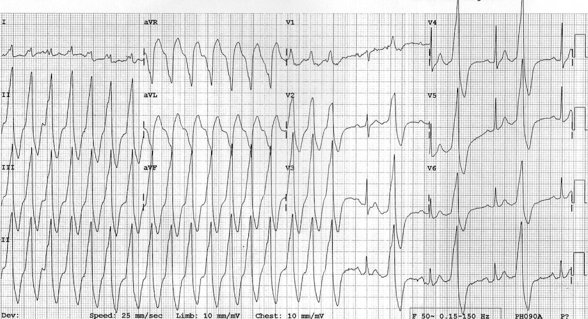 Monomorphic ventricular tachycardia VT 4 and bigeminy