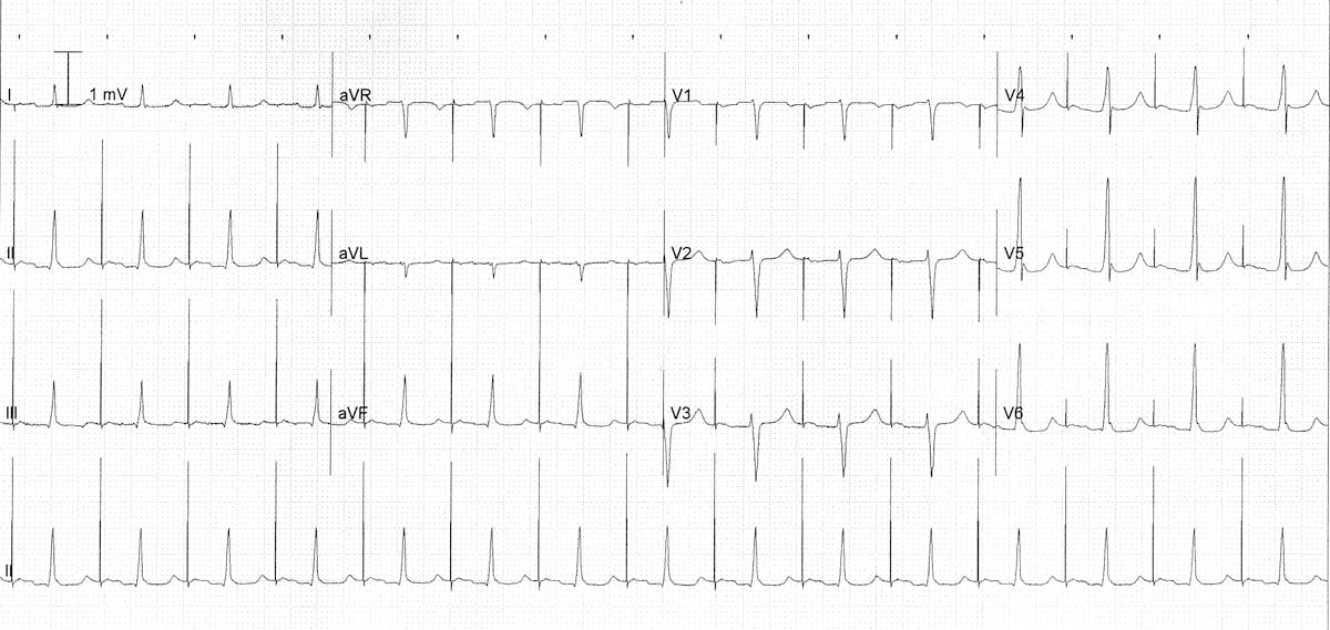 atrial-pacing-1st-degree-AV-block