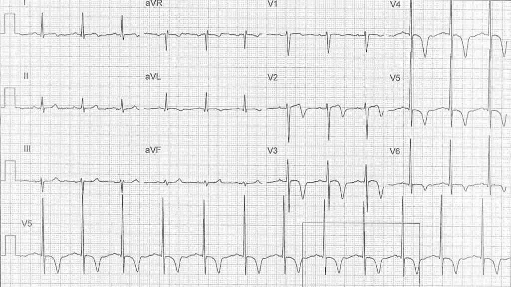 ECG Case 116a LITFL Top 100 EKG