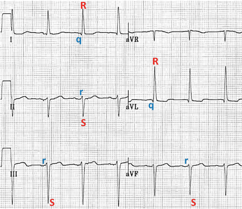 Left Anterior Fascicular Block (LAFB) qR rS complexes