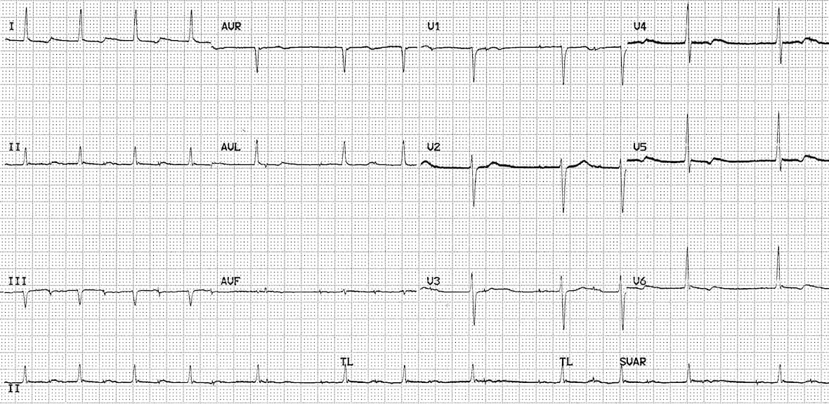 Atrial paced rhythm with Wenckebach conduction