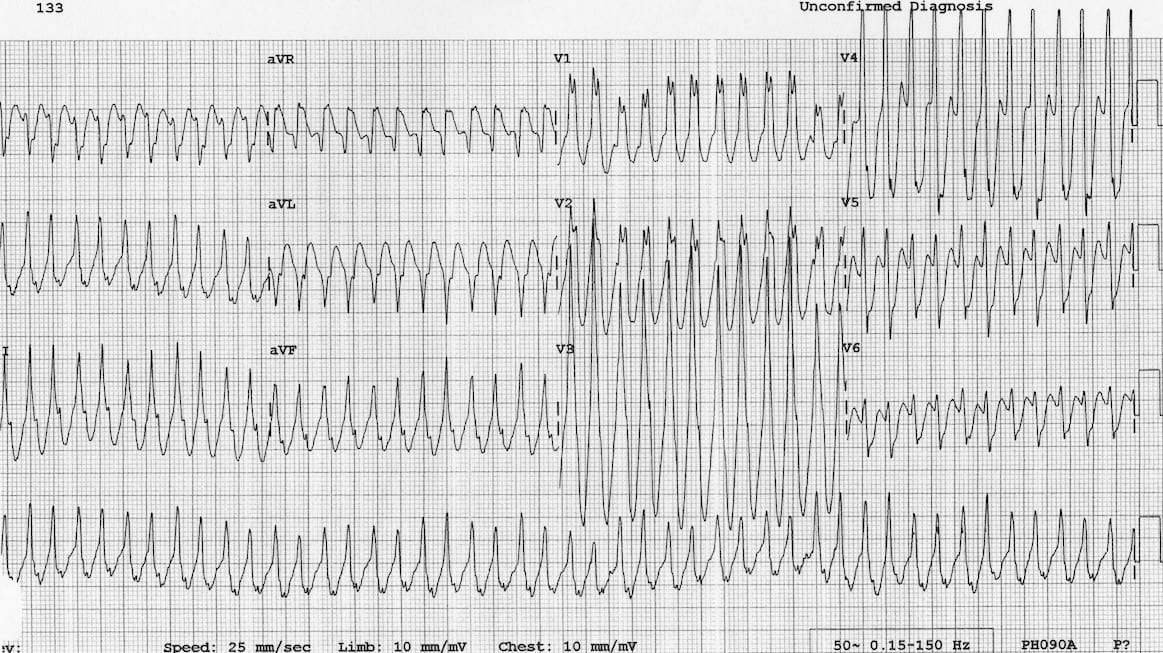 ECG AVRT WPW 5yo boy 2