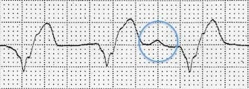AIVR-dissociated-P-wave