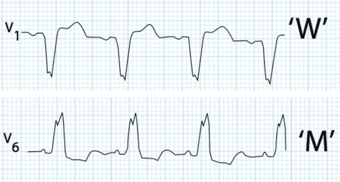 ECG LBBB WILLIAM Morrow