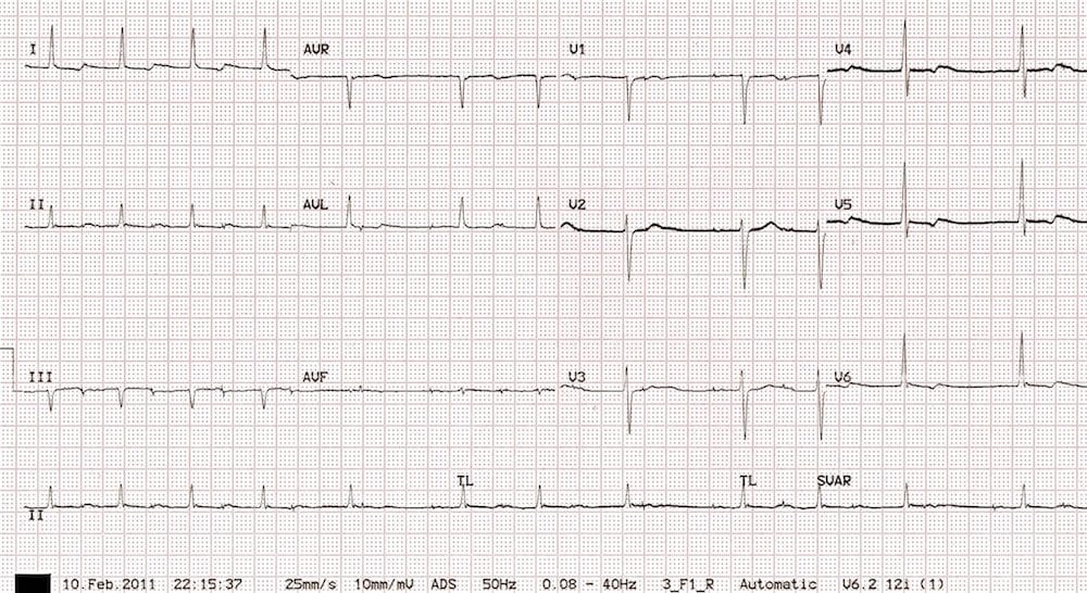ECG 011 Post-op Pacing Puzzler