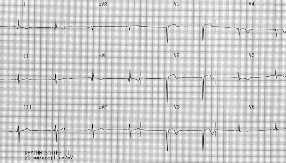 ECG Ventricular Aneurysm