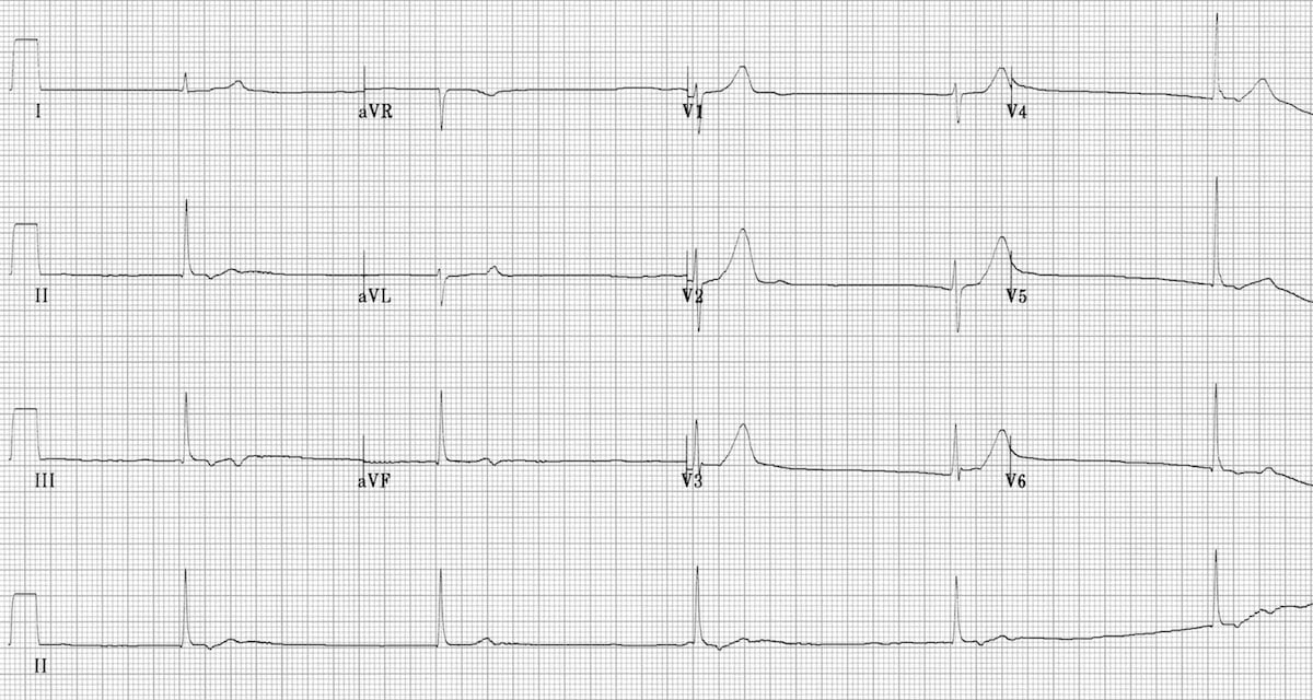 ECG Junctional bradycardia