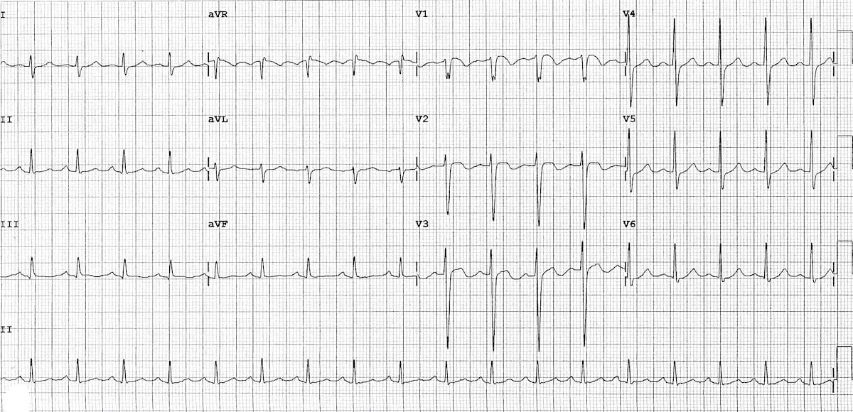 ECG bilateral PE