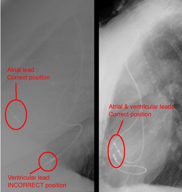 ECG Case 111 Lat cardiac comparison labelled