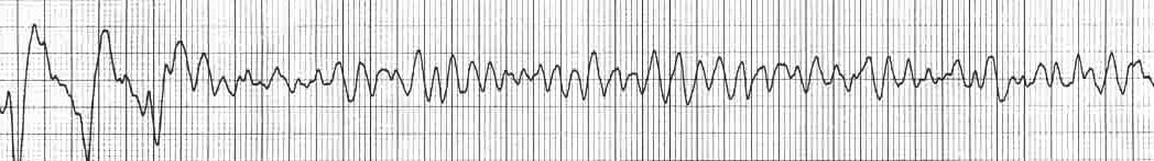 ventricular fibrillation rhythm strip VF shock advised
