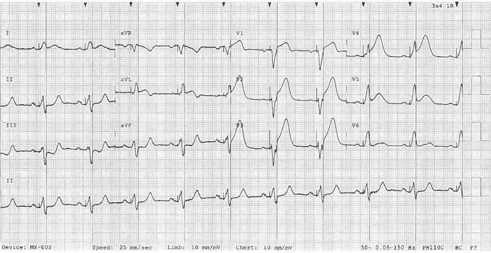 Paced LBBB STEMI Sgarbossa High lateral