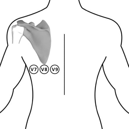 Posterior leads V7 V8 V9 ECG placement
