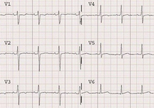 Dynamic T wave flattening due to anterior ischaemia