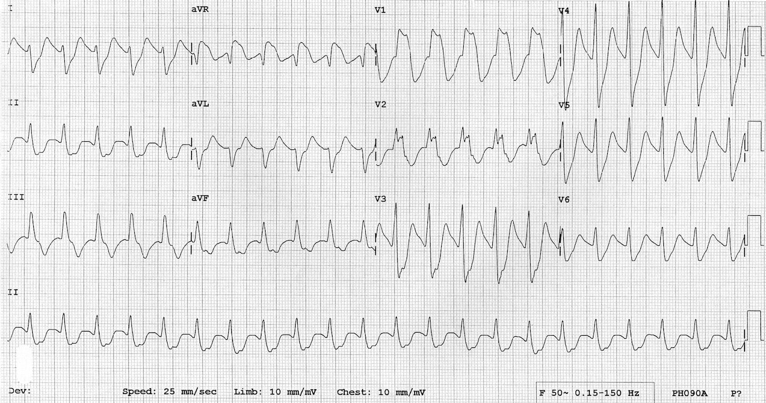 ECG-TCA-Doxepin-Overdose-Toxicology 1200