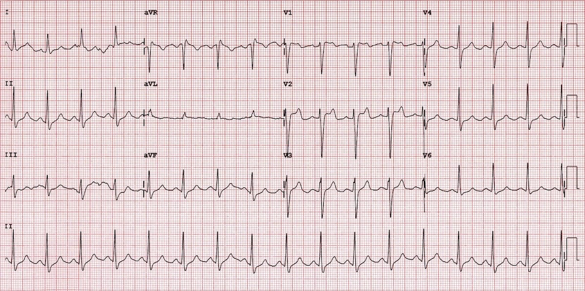 ECG Brugada syndrome Type 2