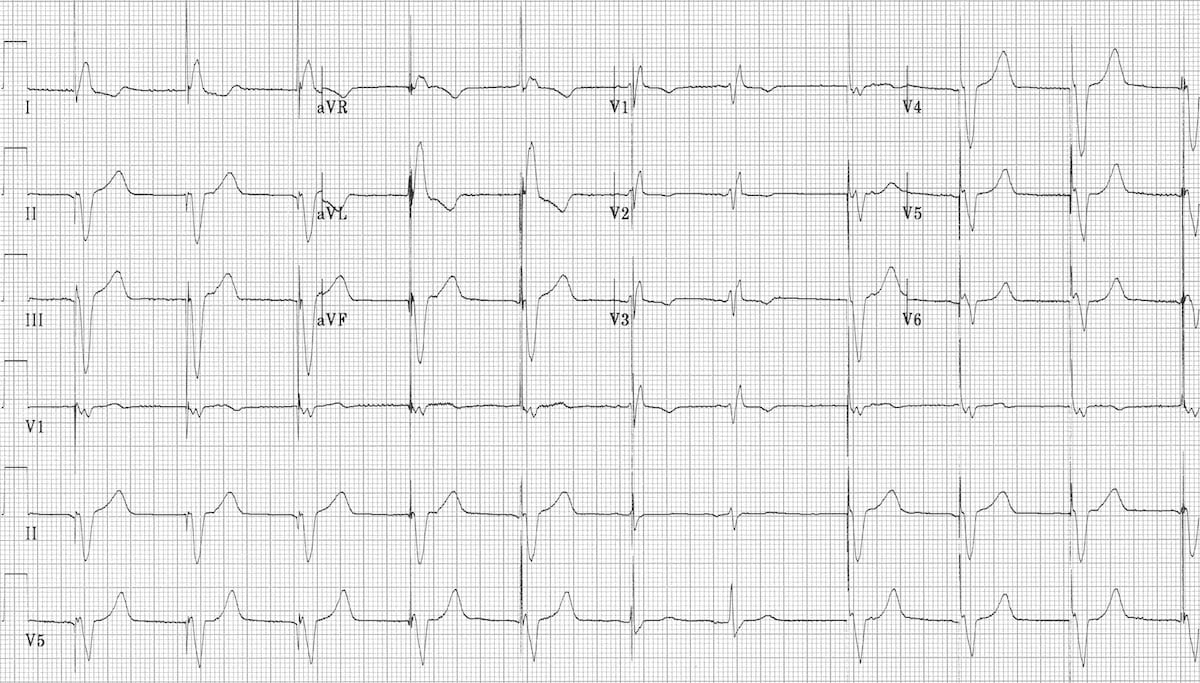 Ventricular pacing with capture beats 2