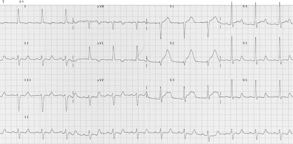 ECG AMI anteroseptal Prolonged Qtc