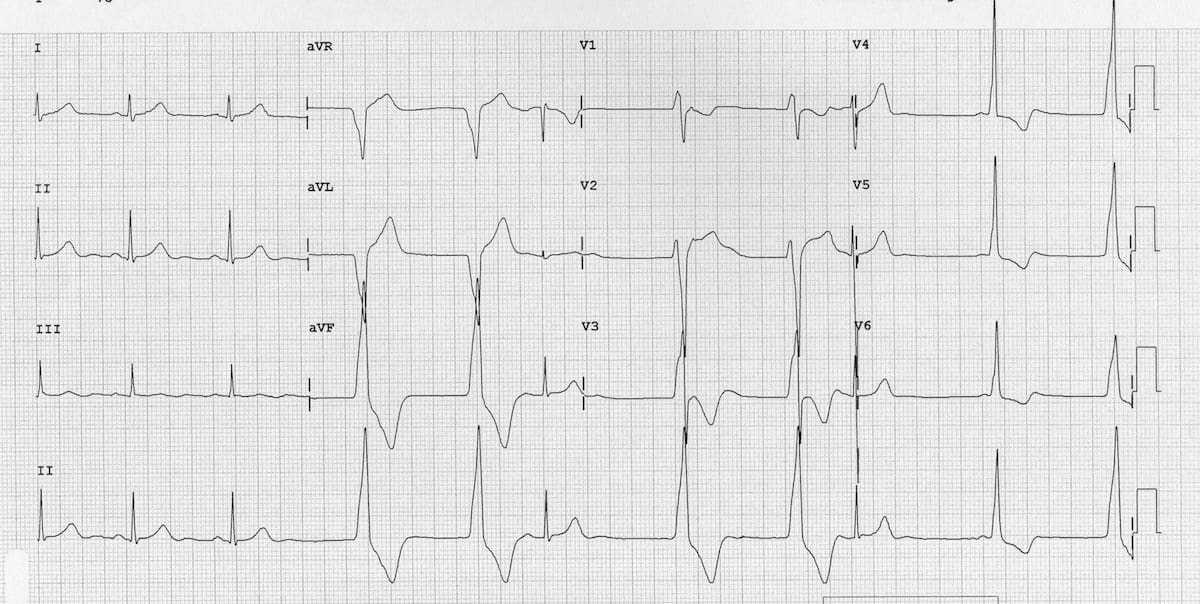 Accelerated Idioventricular Rhythm (AIVR) ECG 2