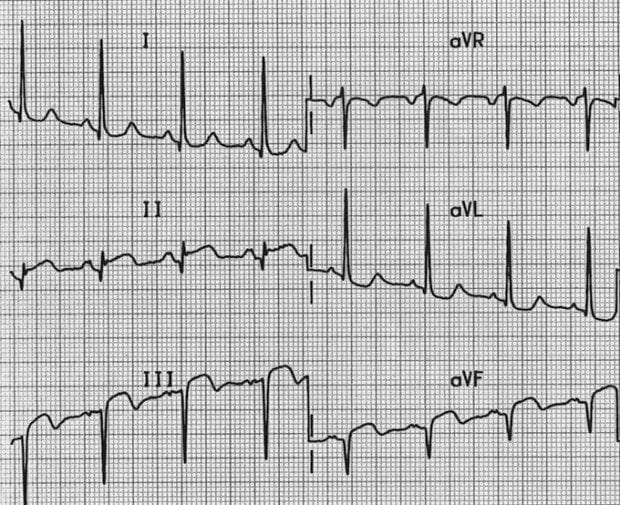 Borderline LAD inferior AMI Axis example 003