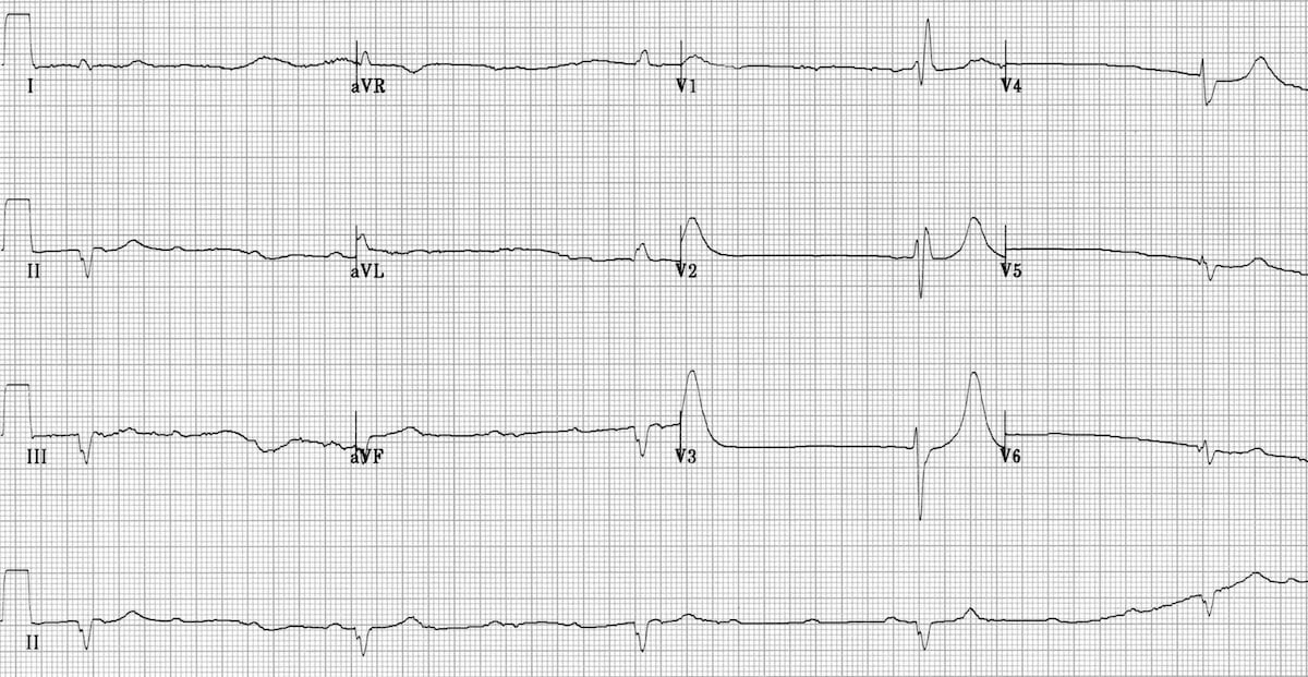 ECG High grade block CHB