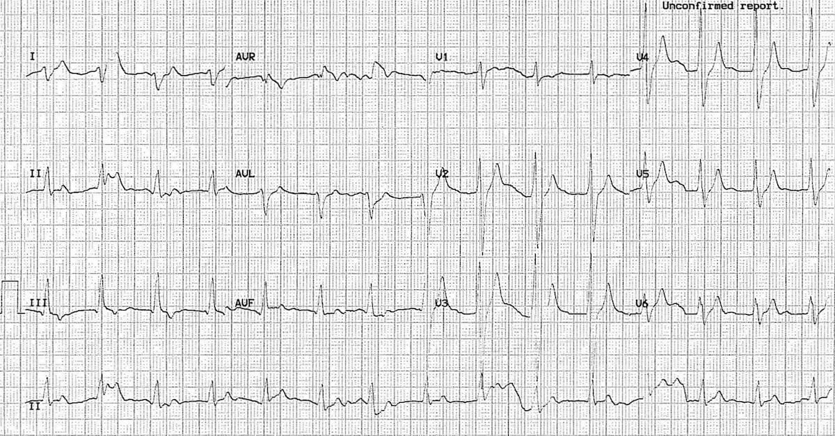 ECG carmbamazepine 3