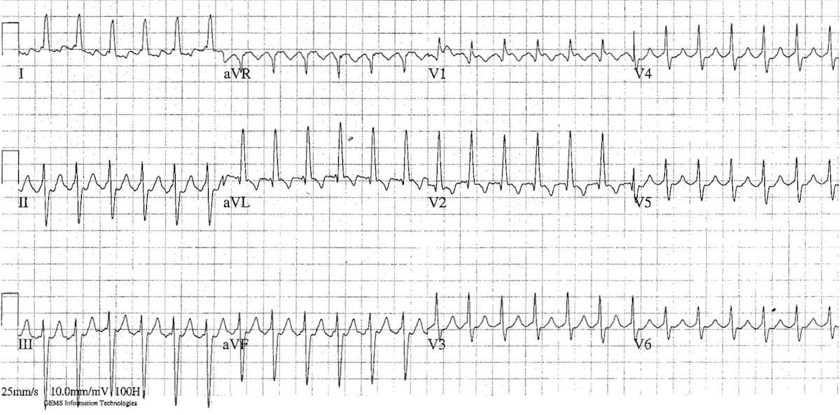 ECG Atrial Flutter 2:1 block