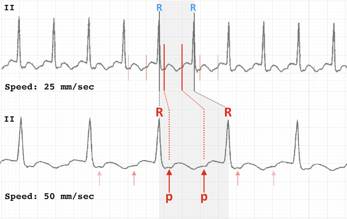 ECG RATE 25 versus 50 mm sec show p waves flutter