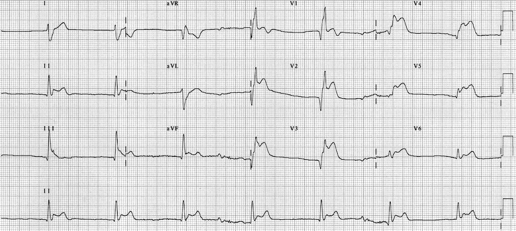ECG Tako-Tsubo Cardiomyopathy