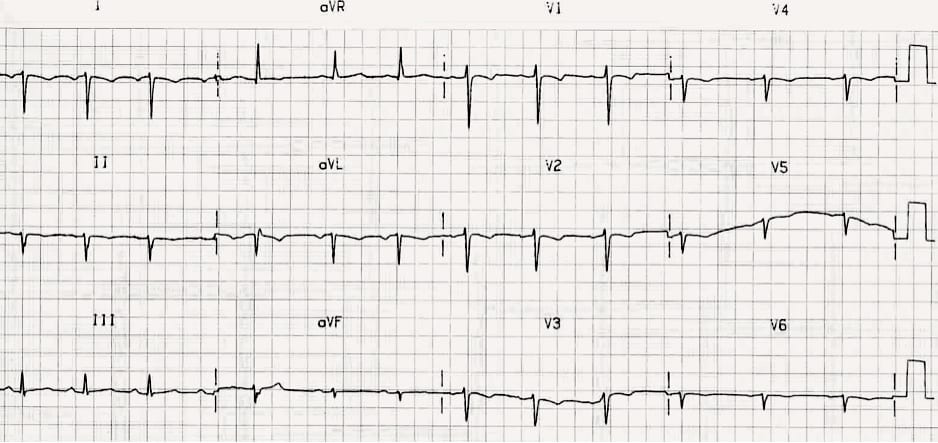 TOP 100 ECG QUIZ LITFL 024