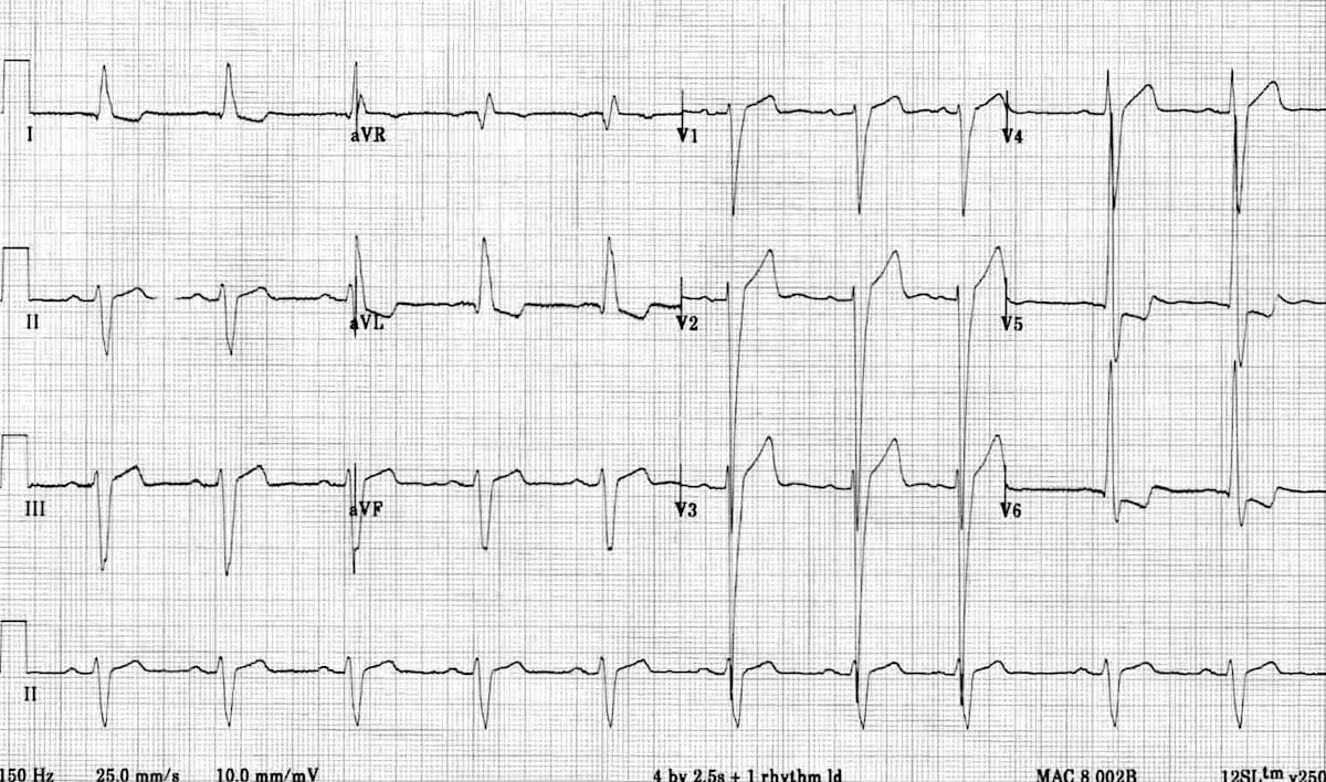ECG Left ventricular hypertrophy (LVH) 2